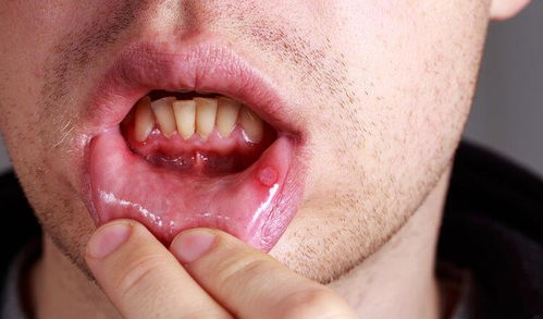 口腔溃疡反复发作,是因为缺维生素 错误的 经验 误导太多人