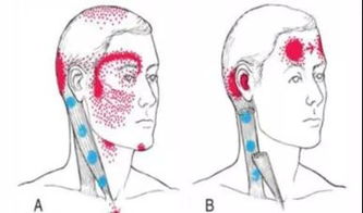 这条肌肉让你头痛,不用吃药就能解决的办法你知道吗