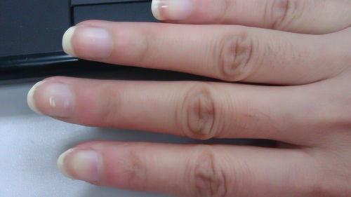 为什么指甲上有竖纹 对身体有什么影响,早知道早受益 