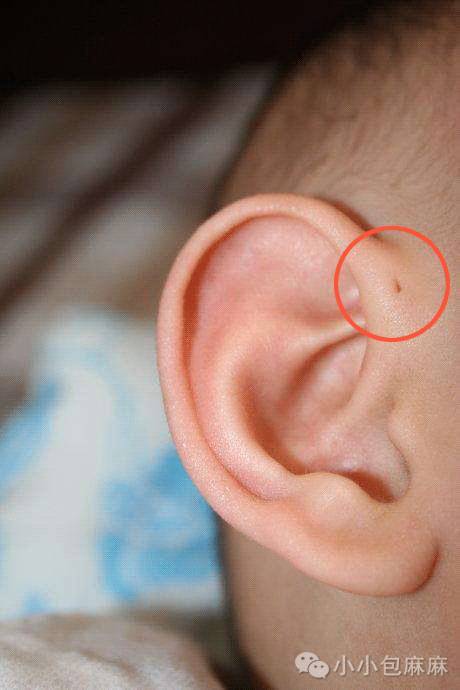 这个小洞一半孩子的耳朵上都有,千万别乱碰