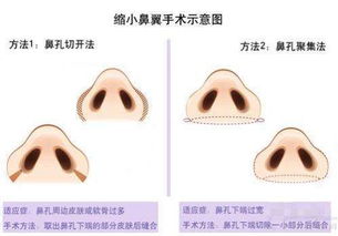 刘天一谈鼻整形 鼻翼缩小手术概述