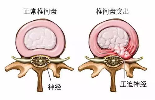 腰椎间盘突出 为什么腰部的毛病会反应到腿上