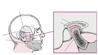 为什么下巴脱臼(为什么下巴脱臼归位还痛)
