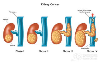 得了肾癌,还能保住肾脏吗