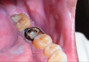 牙齿出现蛀牙如果不做治疗会带来什么危害
