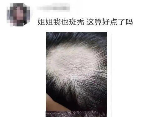 挺 秃 然的 知名女星自爆斑秃,这个问题困扰着许多年轻人......