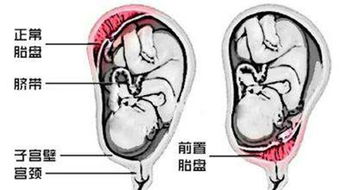 前置胎盘会导致什么并发症 哪些人群易患前置胎盘