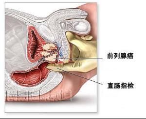 前列腺肿大 搜狗百科 