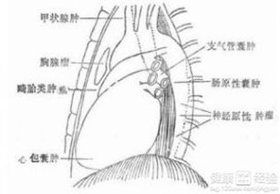 纵隔肿瘤的手术前后护理