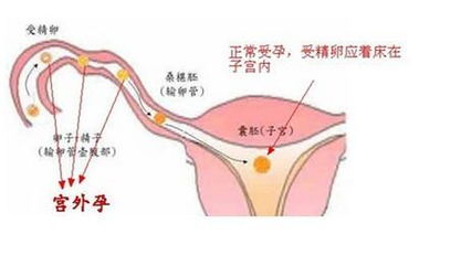 宫外孕 宫外孕有什么症状