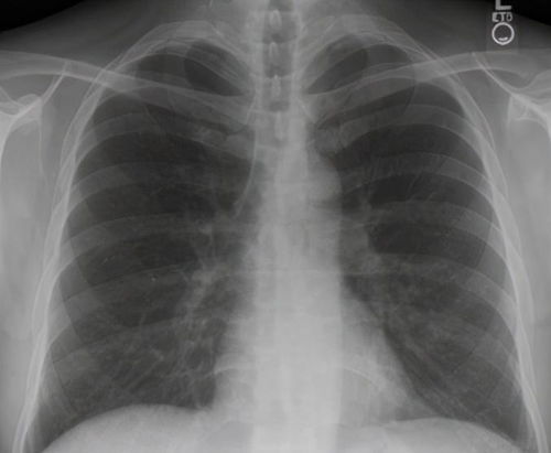 发烧去医院,一天后左肺不见了 医生 死亡率25 的疾病多厉害