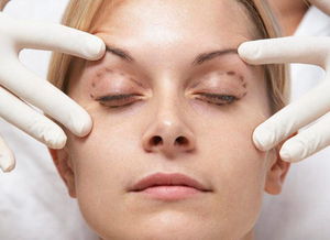 祛眼袋会留疤 或受4个因素影响