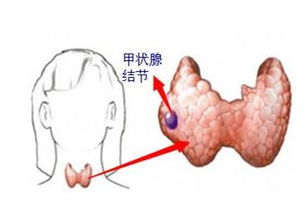 甲状腺结节手术后遗症有哪些