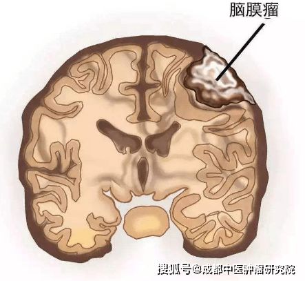 成都中医肿瘤研究院中医杨成平 放疗能抑制脑膜瘤术后瘤细胞生长吗