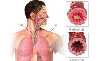支气管哮喘的发病因素有哪些