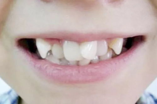 北大口腔周彦恒教授 7岁左右是第一个牙齿矫正黄金期