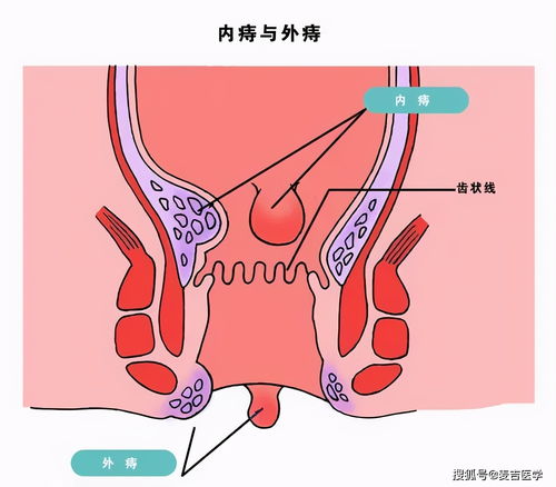 取痔吉日（痔疮割除的最佳时机是什么？）