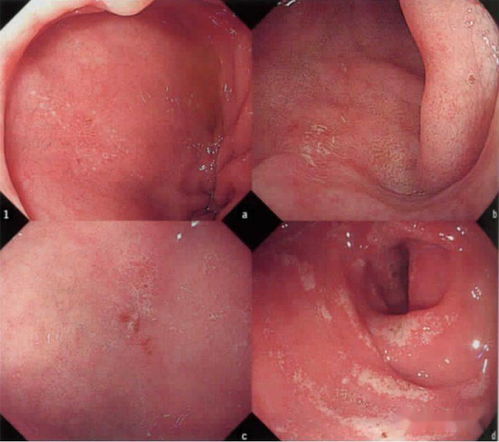 干货收藏 消化内镜40种常见病图谱