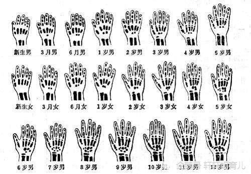 孩子测骨龄真的有用吗 这篇文章让你了解透彻