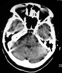 大面积缺血性脑梗塞 大脑中动脉高密度征CT病例