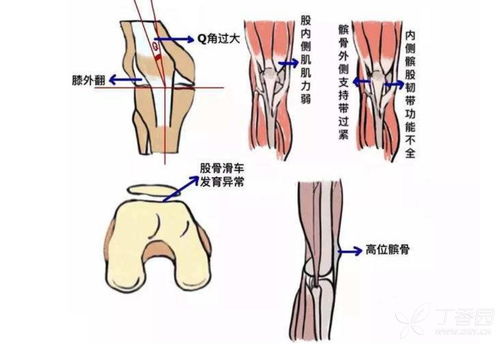 美国怎么治疗髌骨软化？