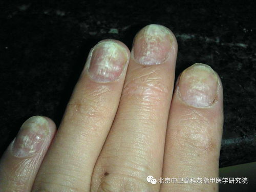 灰指甲有什么症状