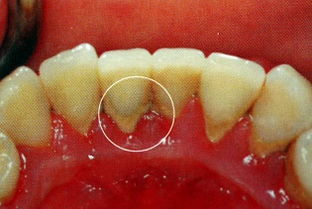 怎么预防牙结石,怎么预防牙结石的产生
