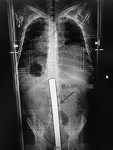 工人跌落被90厘米钢筋扎穿腹 医院消防联合救援脱险 