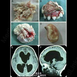 卵巢畸胎瘤图片大全 搜狗图片搜索