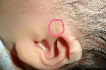 宝宝耳朵上这个洞不是 聪明孔 富贵仓 ,处理不当可能会有严重后果 