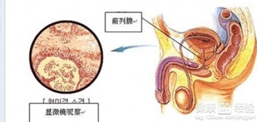 前列腺癌的临床诊断