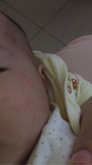 宝宝湿疹三个月宝宝