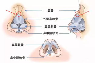 隆鼻 假体隆鼻 用自体软骨隆鼻有什么优势