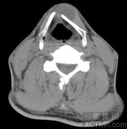 甲状舌骨囊肿 Thyrohyoid cyst CT病例 图文