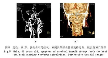 64 层螺旋 CT 血管造影在头颈部血管病变中的临床应用 