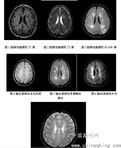 急性轻型脑卒中合并陈旧性腔隙性脑梗死与脑微出血和脑白质疏松的关系 