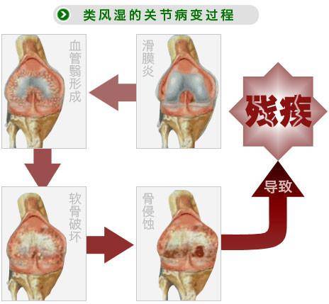 秋季怎么防止类风湿等疾病