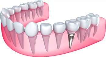 活一颗牙不建议种牙(有一颗牙活了怎么办)
