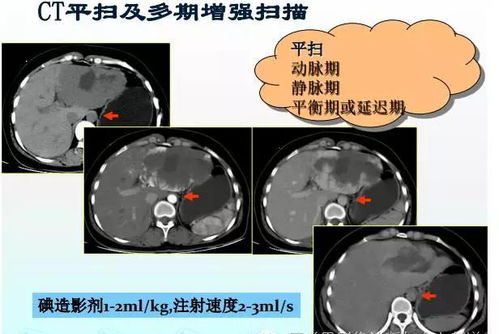 造影剂会过敏 增强CT没有必要做 医生总结了5点实用化建议