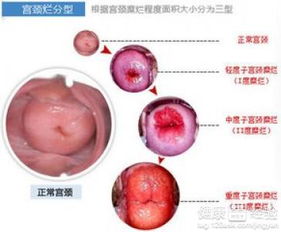 宫颈糜烂用什么药最好