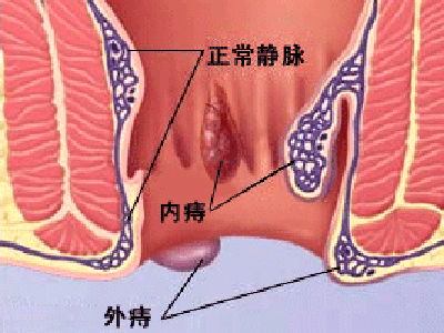 直肠痔疮的症状 -图2