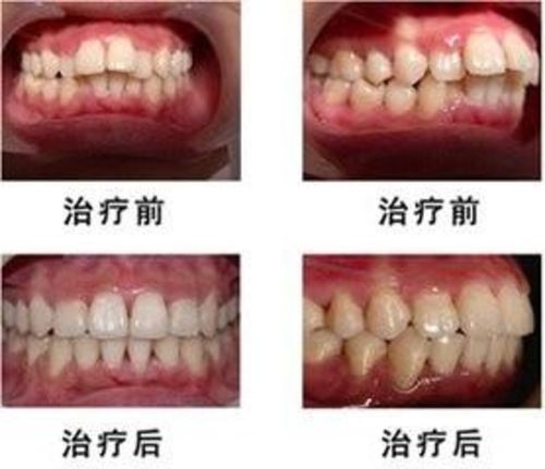 牙齿矫正还会增加法令纹