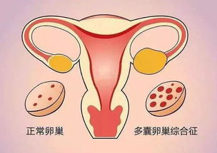 多囊卵巢综合征中药治疗备孕,多囊卵巢综合征中医怎么治疗啊
