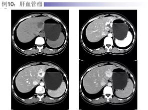 CT增强检查的临床意义