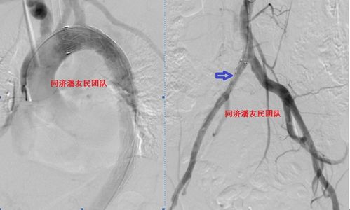 主动脉夹层Ⅲ放支架后多久能过正常认得生活