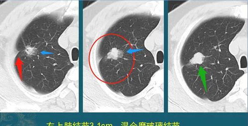 癌症治不治都一样,不治就不会人财两空 医生带您看癌症3个结局