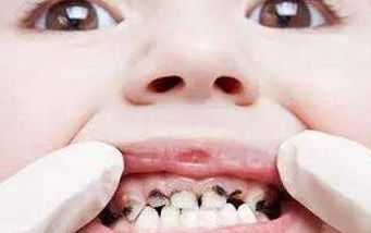 你不知道的孩子4种行为,是导致蛀牙的 元凶 不仅仅是爱咬糖