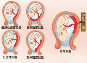 胎盆低了有什么危险、再者胎盆怎么会低呢是什么原因而低的呢