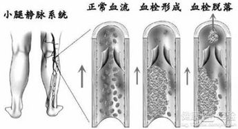 骨折后形成血栓，并且植入滤网，这是怎么回事(骨折术后血栓危险期)