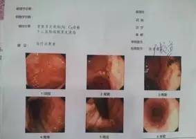 女子半夜胃绞痛,一查竟是胃癌 直肠癌 胃肠不好赶快看看吧 